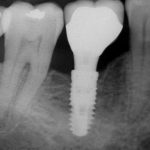 Implantati ali umetne zobne korenine